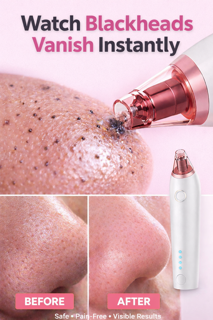 Deep Pore Blackhead Vacuum – Clear Skin in Minutes